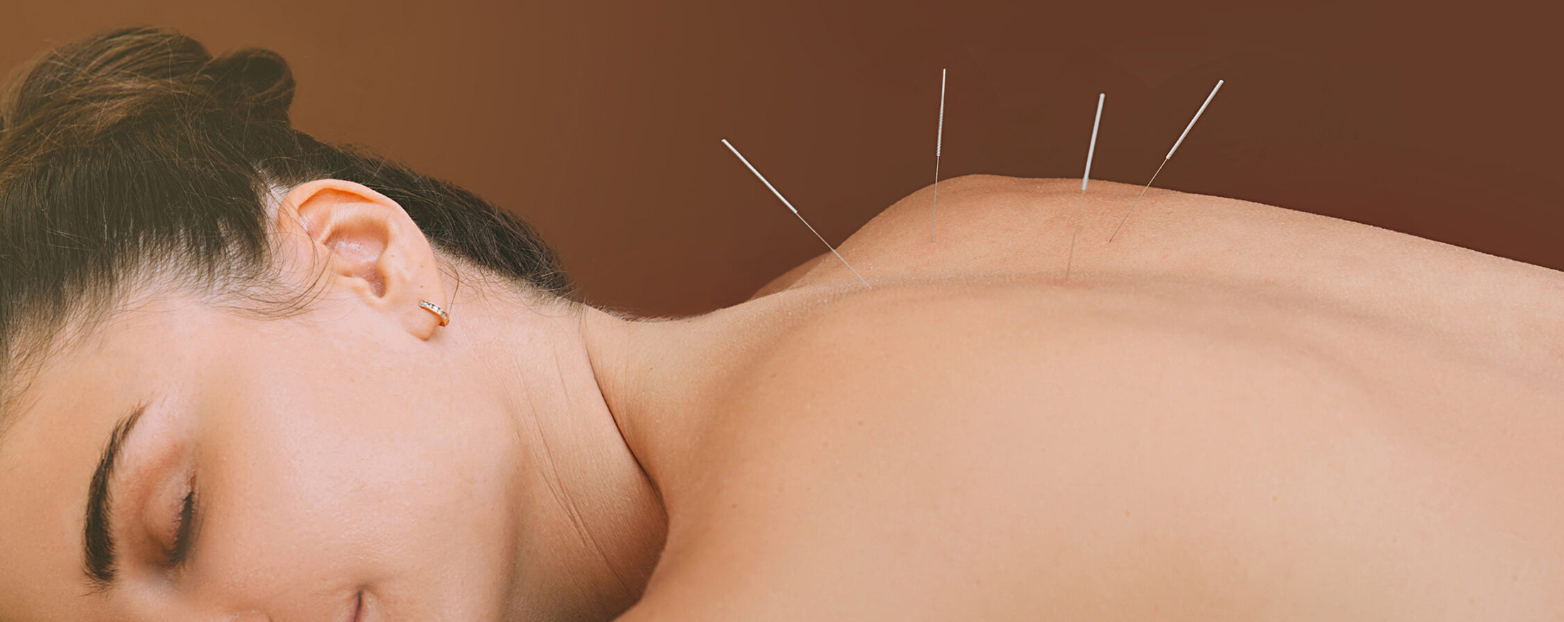 Acupuncture in Saffron Walden by Vanessa Acupuncture