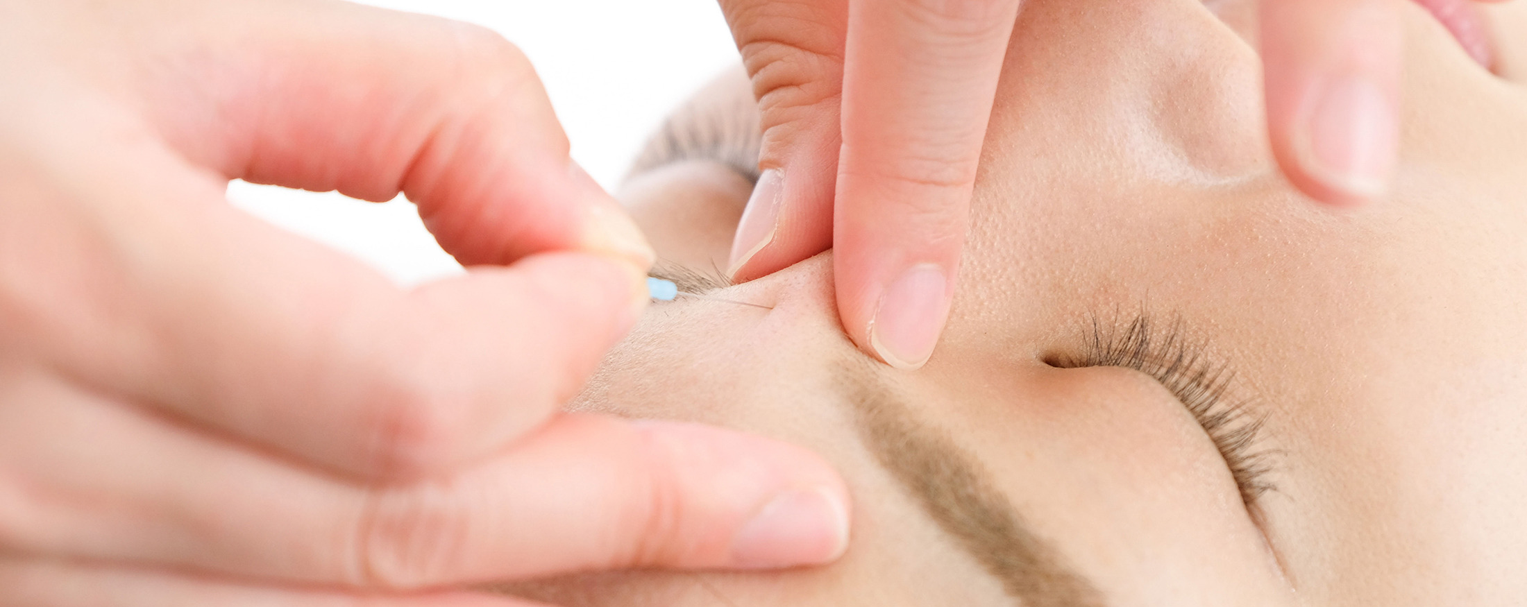 Acupuncture in Saffron Walden by Vanessa Acupuncture